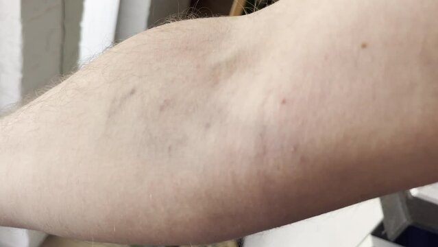Vein hematoma of patient's arm after intravenous dripping in hospital before operation, vein injection for treatment, blood samples for clinical researches, vein bruise of drug addict person