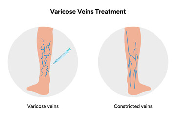 Varicose veins treatment,  Sclerotherapy