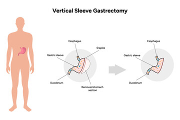 Vertical Sleeve Gastrectomy 