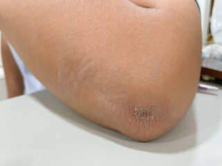 Dry elbow from friction. Dry and thicken skin on elbow.