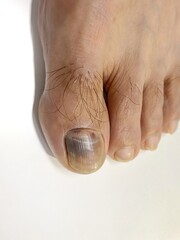 Abstract photo of Bruised toenail with white background. Black nail on big toe cause by running.