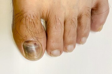 Abstract photo of Bruised toenail with white background. Black nail on big toe cause by running.