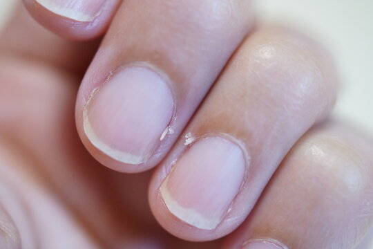 指のささくれ　さかむけ　アップ