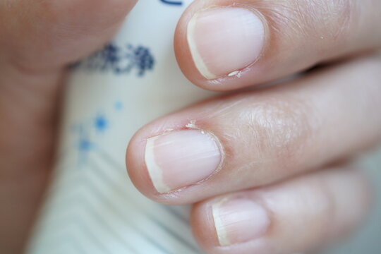 洗剤を持つ手指のささくれ　さかむけ　アップ