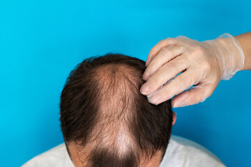 Baldness, a man is examined by a doctor in gloves on a blue background close-up.