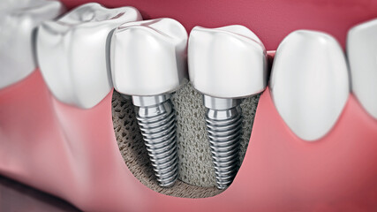 3D illustration of two dental implants on the lower jaw - 792625331