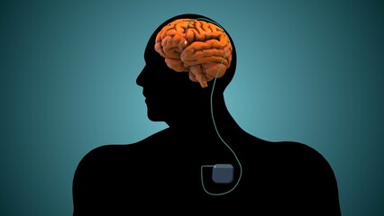 The medical notion of deep brain stimulation
