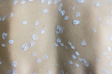 a chickenpox rash on the body of a young man. chickenpox. traces of the disease. skin disease