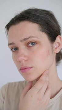 Selfie portrait of young  pretty woman showing her acne rashes on her face. Worrying about skin problems. Natural beauty skin care