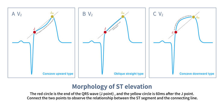 According to the offset amplitude of the ST segment at J point and J60 point, ST segment elevation can be divided into three basic types: concave upward, oblique straight and concave downward type.
