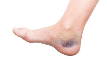 close up of foot with injury, sprain, strain, inflammation, kinesiology