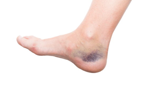 close up of foot with injury, sprain, strain, inflammation, kinesiology - Powered by Adobe