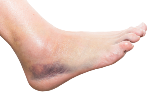 close up of foot with injury, sprain, strain, inflammation, bruise, kinesiology