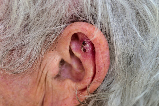 Basal Cell Carcinoma on an ear from over exposure to UVA particularly sunlight, resulting in the need for an operation to remove it
