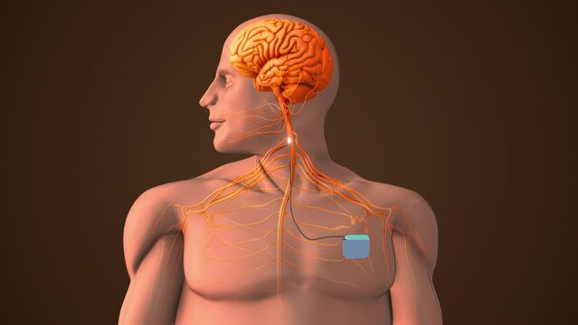 Medical treatment with Vigus Nerve Stimulation