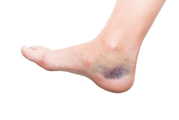 close up of foot with injury, sprain, strain, inflammation, kinesiology - obrazy, fototapety, plakaty