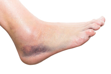 close up of foot with injury, sprain, strain, inflammation, bruise, kinesiology