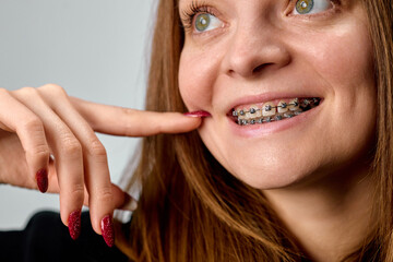 Portrait of a young smiling woman with braces to correct her bite