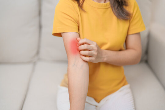 woman itching and scratching itchy arm. Sensitive Skin Allergic reaction to insect bite, food, drug dermatitis. Dermatology, Leprosy day, Systemic lupus erythematosus, Allergy symptoms and rash Eczema