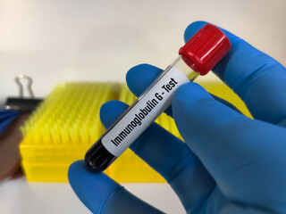 Blood sample for Immunoglobulin A, G and M test at medical laboratory