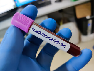 Blood sample for Growth Hormone (GH) test. To diagnosis hormonal imbalance.