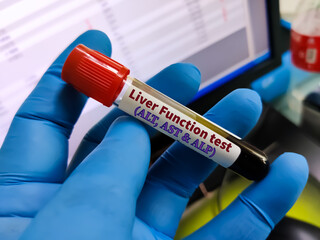 Blood sample for Liver Function test (ALT, AST and ALP). To diagnosis liver disease.