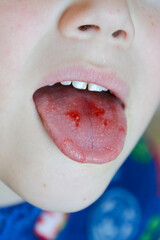  Close-up of lips, tongue, protrusion of blood. Child's bitten tongue.