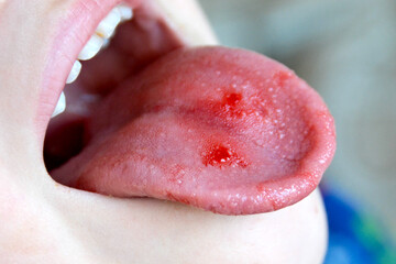  Close-up of lips, tongue, protrusion of blood. Child's bitten tongue.