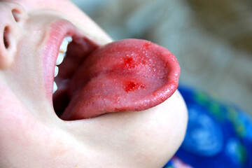  Close-up of lips, tongue, protrusion of blood. Child's bitten tongue.
