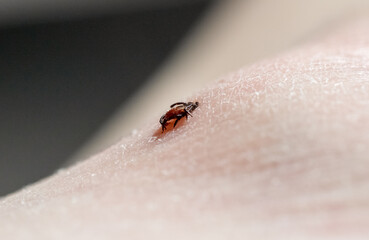 A tick embedded in a person skin.