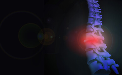 Wirbelsäule Rücken des Menschen - Bandscheibenvorfall mit Schmerzen - Gesundheit und Therapie - Medizin Diagnose und Behandlung