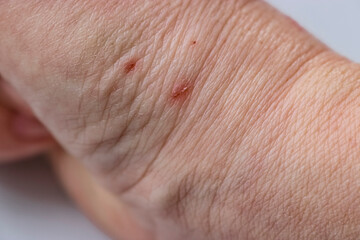 Close-up of scratches on the skin of the wrist. A wound caused by a cat. Selective Focus - 794718759