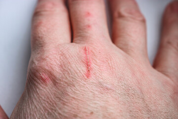 Close-up of a pet owner's scratched hand. Selective Focus