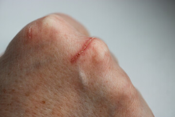 Close-up of a scratched wound on the hand of a mature woman. Selective Focus