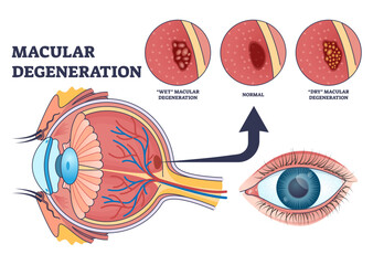 Macular degeneration as eye illness and eyesight problem outline diagram, transparent background. Labeled educational scheme with central vision loss disease with wet or dry types illustration.
