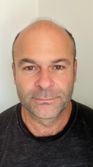 Fototapeta premium An image capturing a man before undergoing a hair transplant procedure, showcasing his initial hair loss or balding condition prior to treatment. 