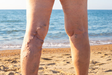 woman at sea with sore legs, bumps on her shins, thrombophlebitis of the veins of the lower extremities