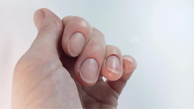 Blood due to careless cutting of the cuticle. Unprofessional traumatic manicure at home. Close-up shot of the woman's hand and nails