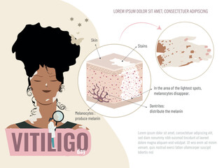 A woman with black hair and a green shirt is shown with an illustration of a skin condition called vitiligo. Graphic scheme of the skin with this disease.Vitiligo disease education concept