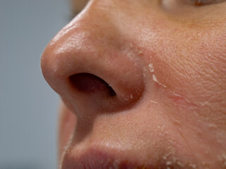 CLOSE UP, DOF: Peeling of dry skin around the nose and cheeks of a young person. Harmful consequences due to carelessness in summer sunbathing, which can gradually lead to development of skin cancer.