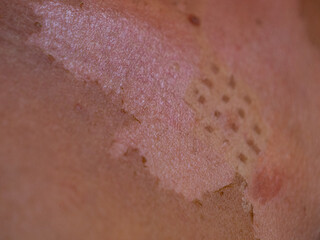 Fototapeta premium CLOSE UP, DOF: Severely damaged epidermis after overexposure to the summer sun. Peeling red and dry skin with a visible white necklace pendant mark. Careless sunbathing and dangerous sun exposure.