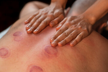 Close-up of the masseur's hands on the man's back with traces of vacuum therapy. Alternative...