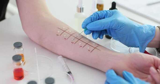 Skin prick test for allergies in the clinic