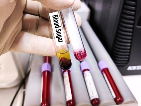 Blood sample in glass test tube for Sugar or Glucose biochemistry test. To diagnosis diabetics by enzymatic endpoint method