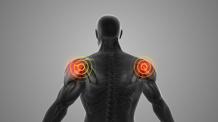 Shoulder discomfort that trigger pain