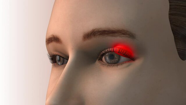 Close up of eye swollen eyelid from a bacterial infection