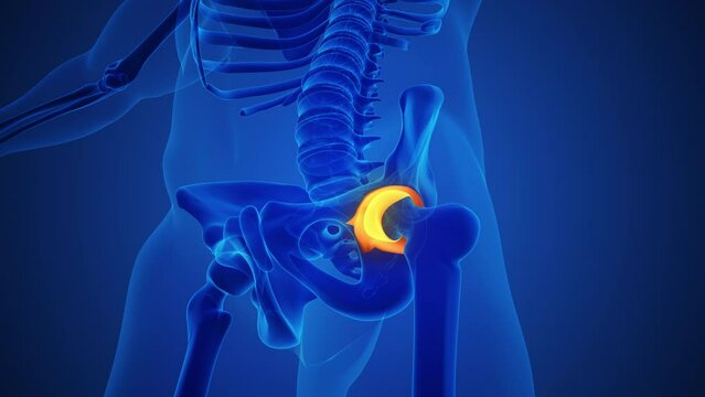 Skeleton with osteoarthritis hip joint injury