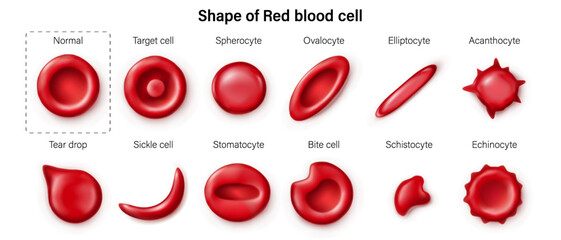 Shape variation of red blood cell morphology. Normal and abnormal erythrocytes. Target cell, Spherocyte, Ovalocyte, Elliptocyte, Acanthocyte, Tear drop, Sickle cell, Stomatocyte, Schistocyte and Echin