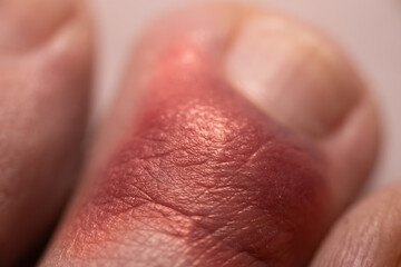 Hematoma on the toe. Hemorrhage under the skin. Broken toe