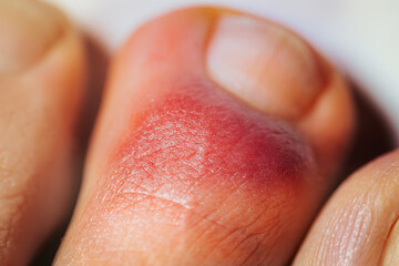 Hematoma on the toe. Hemorrhage under the skin. Broken toe